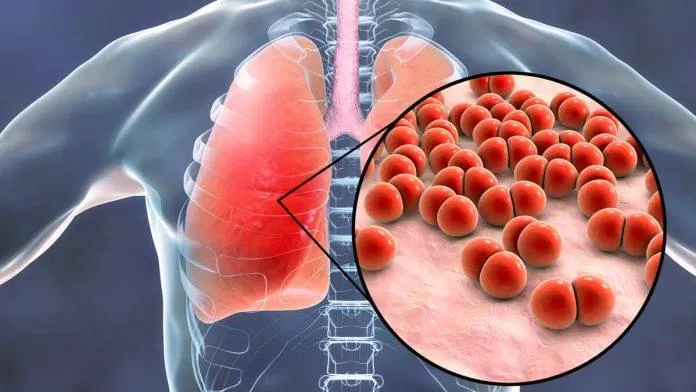 Giảm nguy cơ mắc bệnh viêm phổi (ảnh: Internet)