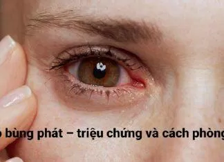[Góc cảnh báo] Dịch đau mắt đỏ bùng phát - triệu chứng và cách phòng tránh - Nguồn internet