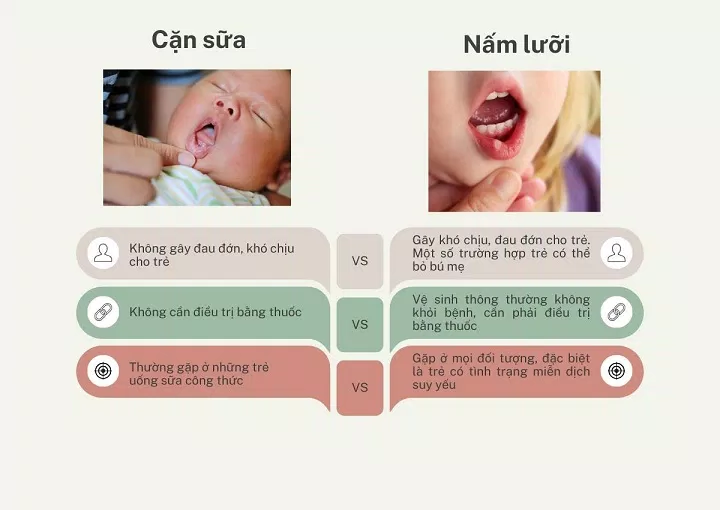 Trẻ bị nấm lưỡi miệng, đặc điểm nhận diện và cách xử trí như thế nào? (Ảnh: Internet)