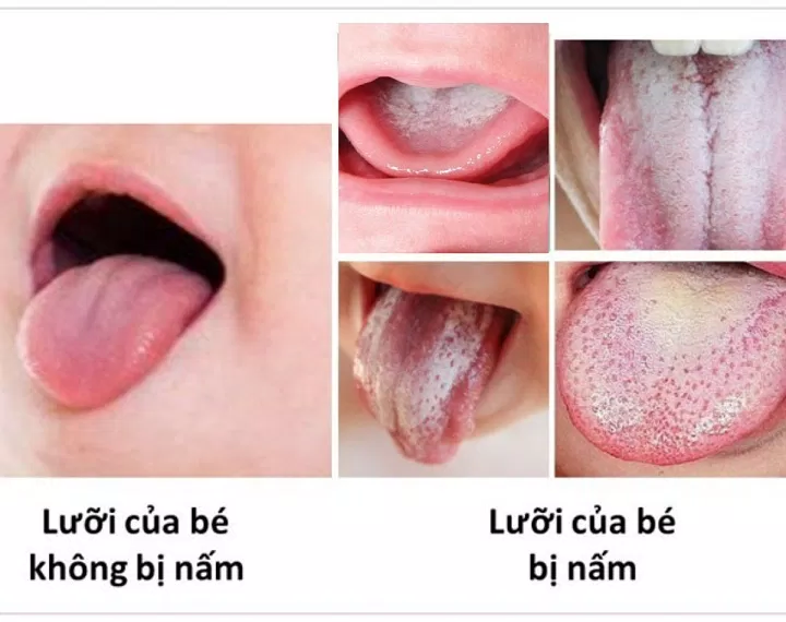 Trẻ bị nấm lưỡi miệng, đặc điểm nhận diện và cách xử trí như thế nào? (Ảnh: Internet)