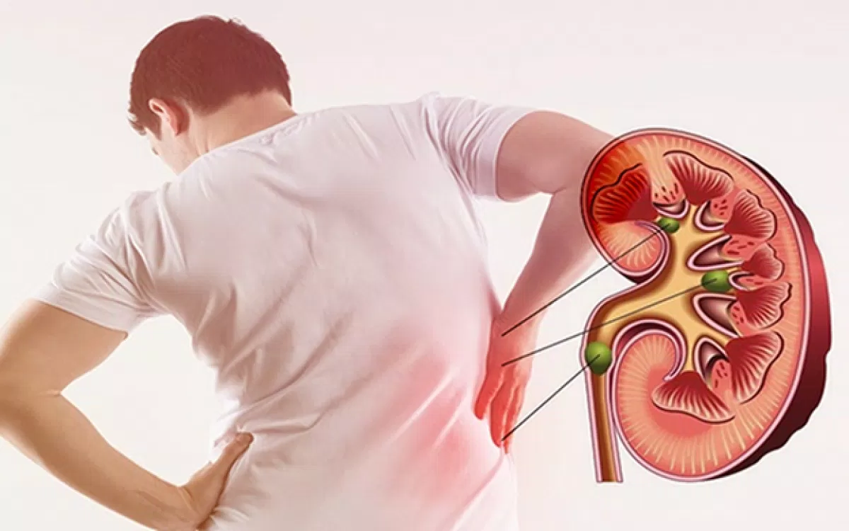 Tăng axit uric có thể gây nguy hiểm cho thận (Ảnh: Internet) Tăng axit uric có thể gây nguy hiểm cho thận (Ảnh: Internet)