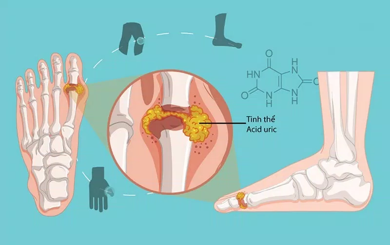 Axit uric tích tụ trong khớp gây ra bệnh gút (Ảnh: Internet)