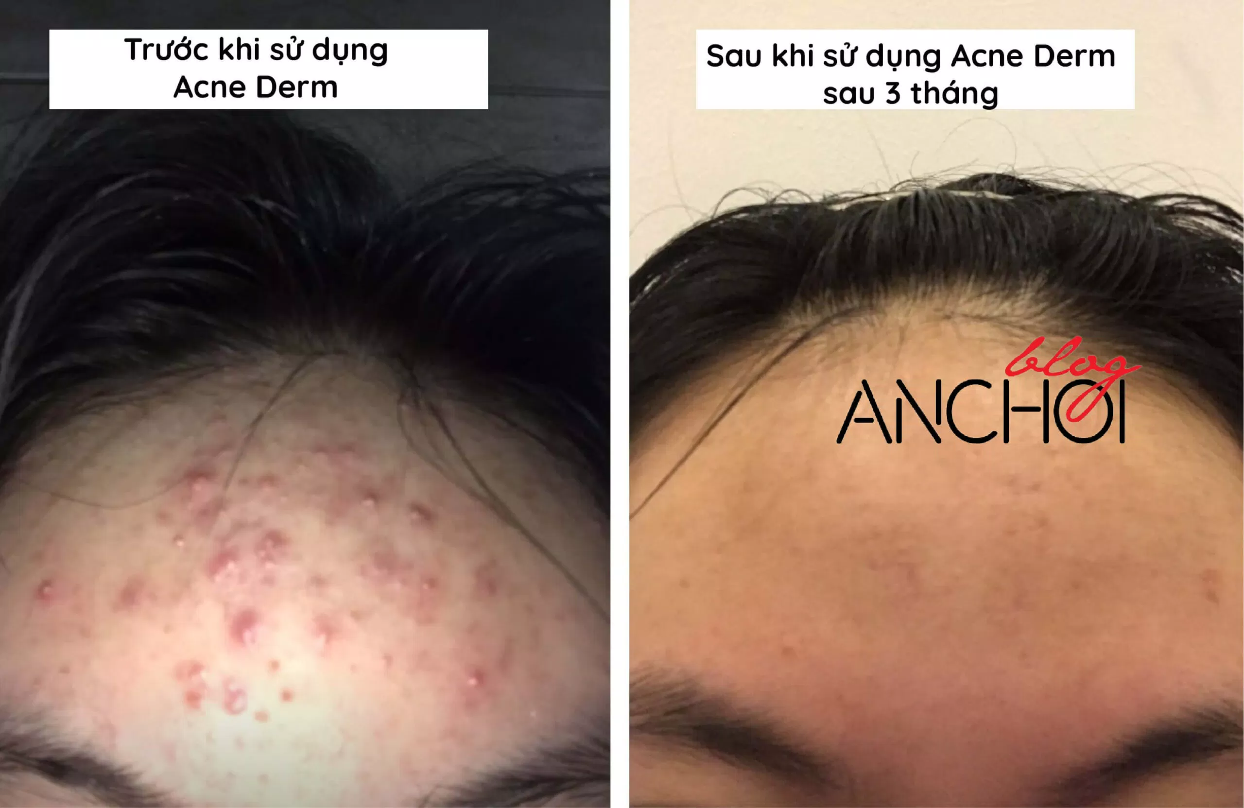 Hình ảnh trước và sau khi sử dụng kem trị mụn Acne Derm Kwas Azelainowy 20% của tác giả