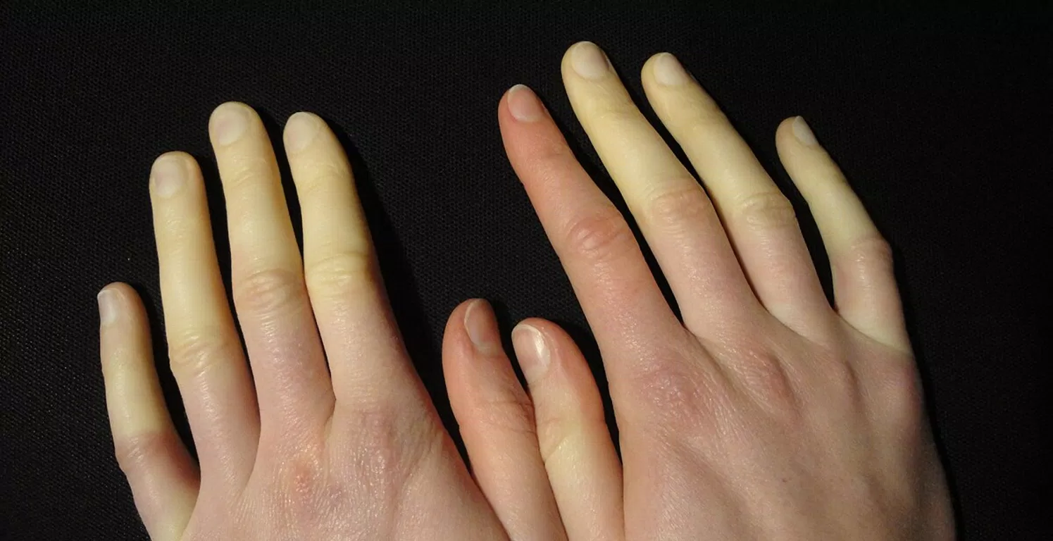 Raynaud