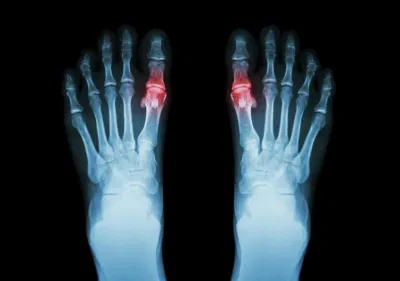 Nốt tinh thể urat (tophi) hình thành dưới da ngườ bị gout
