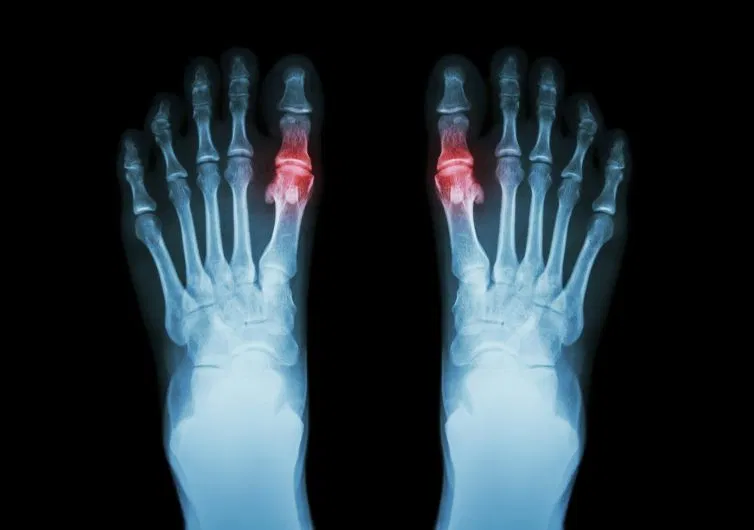Nốt tinh thể urat (tophi) hình thành dưới da ngườ bị gout