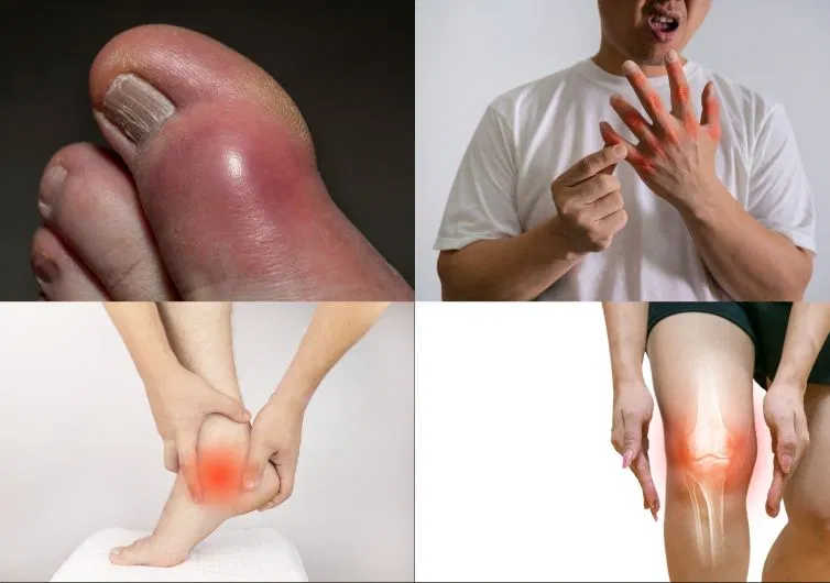 Triệu chứng bệnh gout thường gặp
