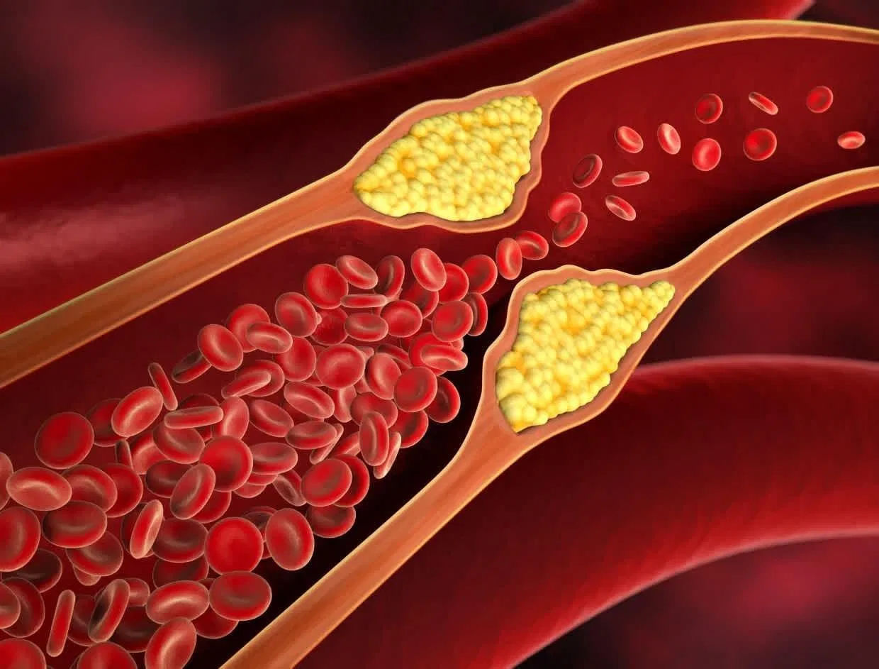 Cholesterol cao