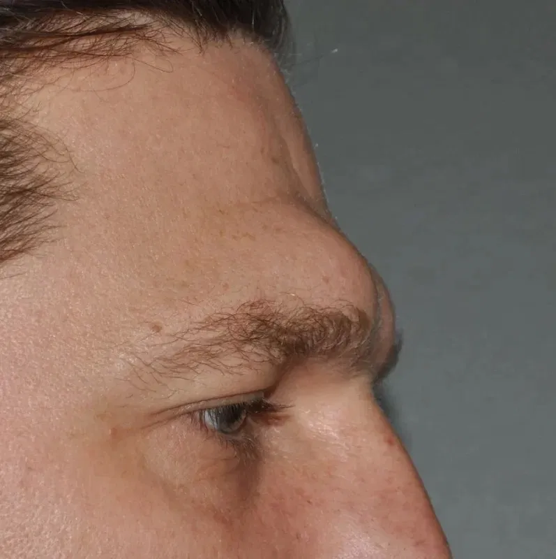 Tướng trán lộ xương lông mày (Ảnh: Internet)