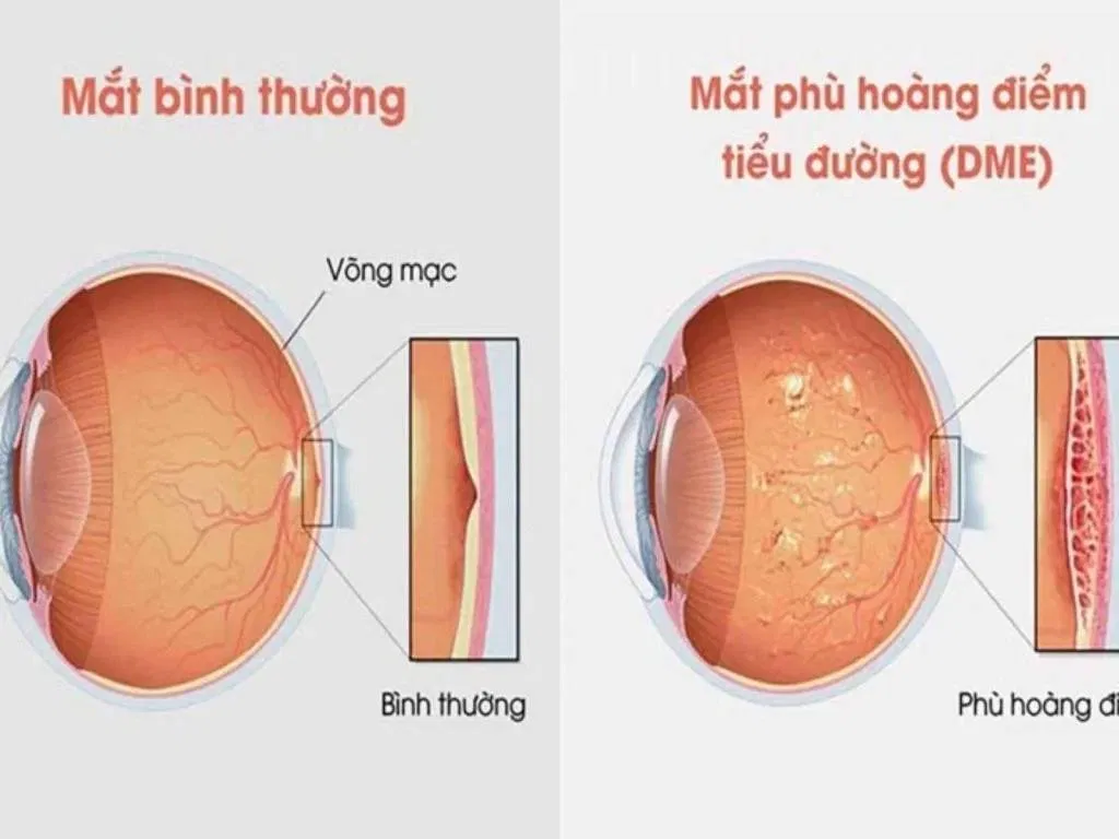 Phù hoàng điểm do tiểu đường