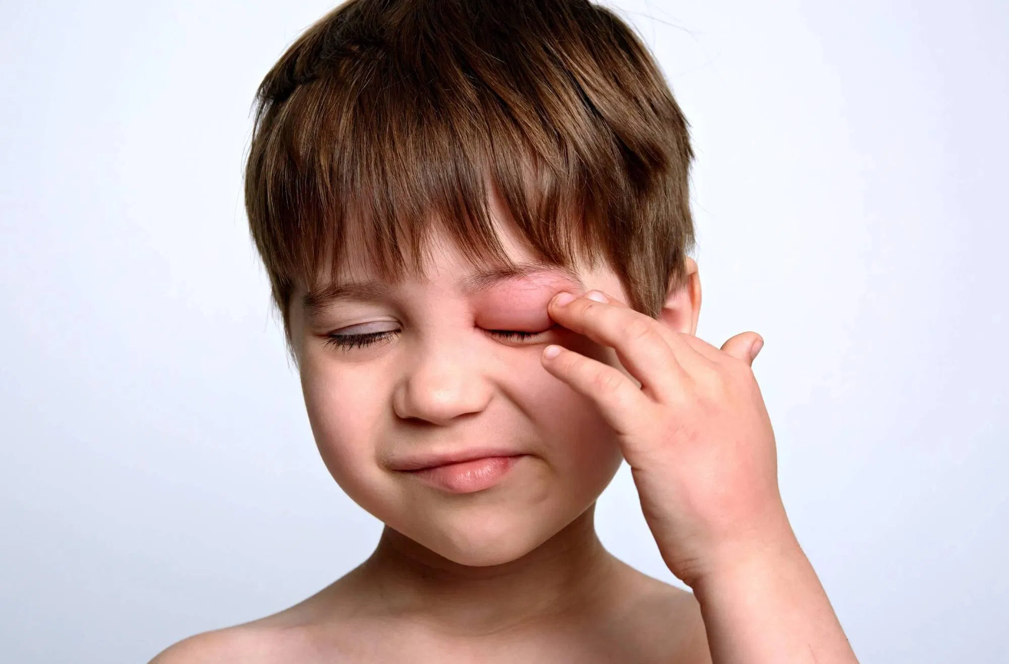 Viêm mô tế bào quanh hốc mắt thường xảy ra do sự xâm nhập của vi khuẩn