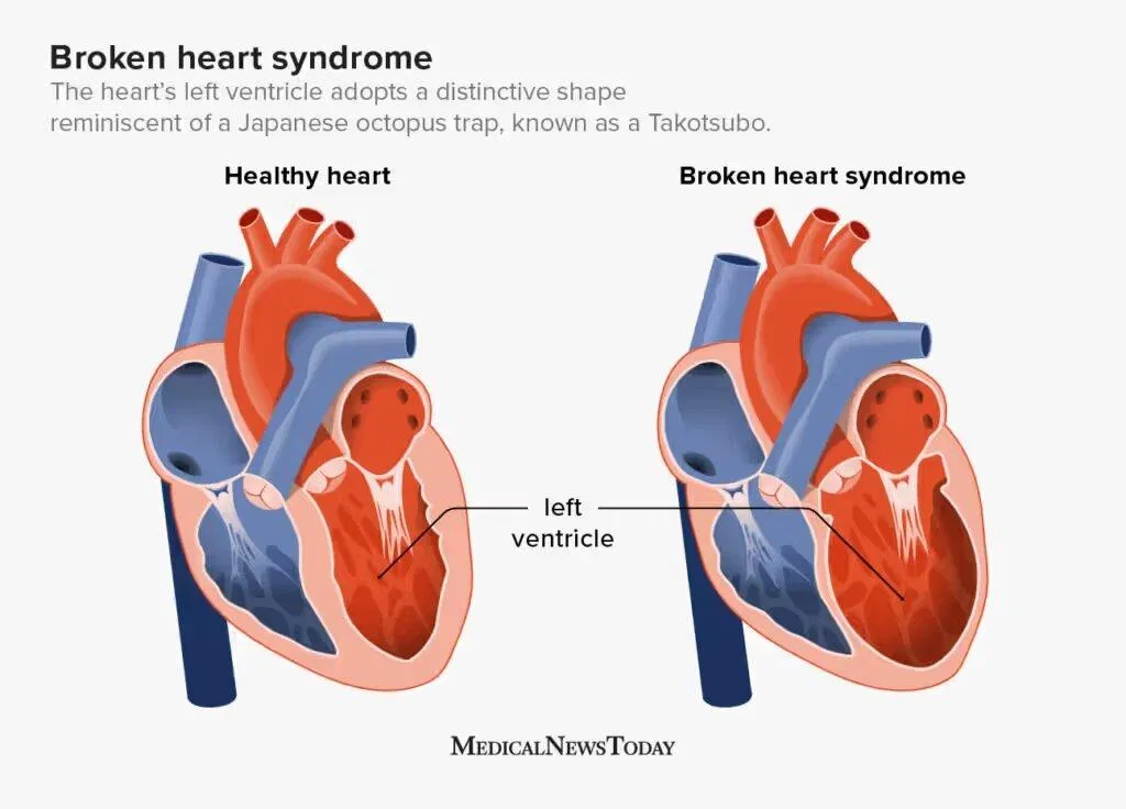 Hội chứng Tim Vỡ