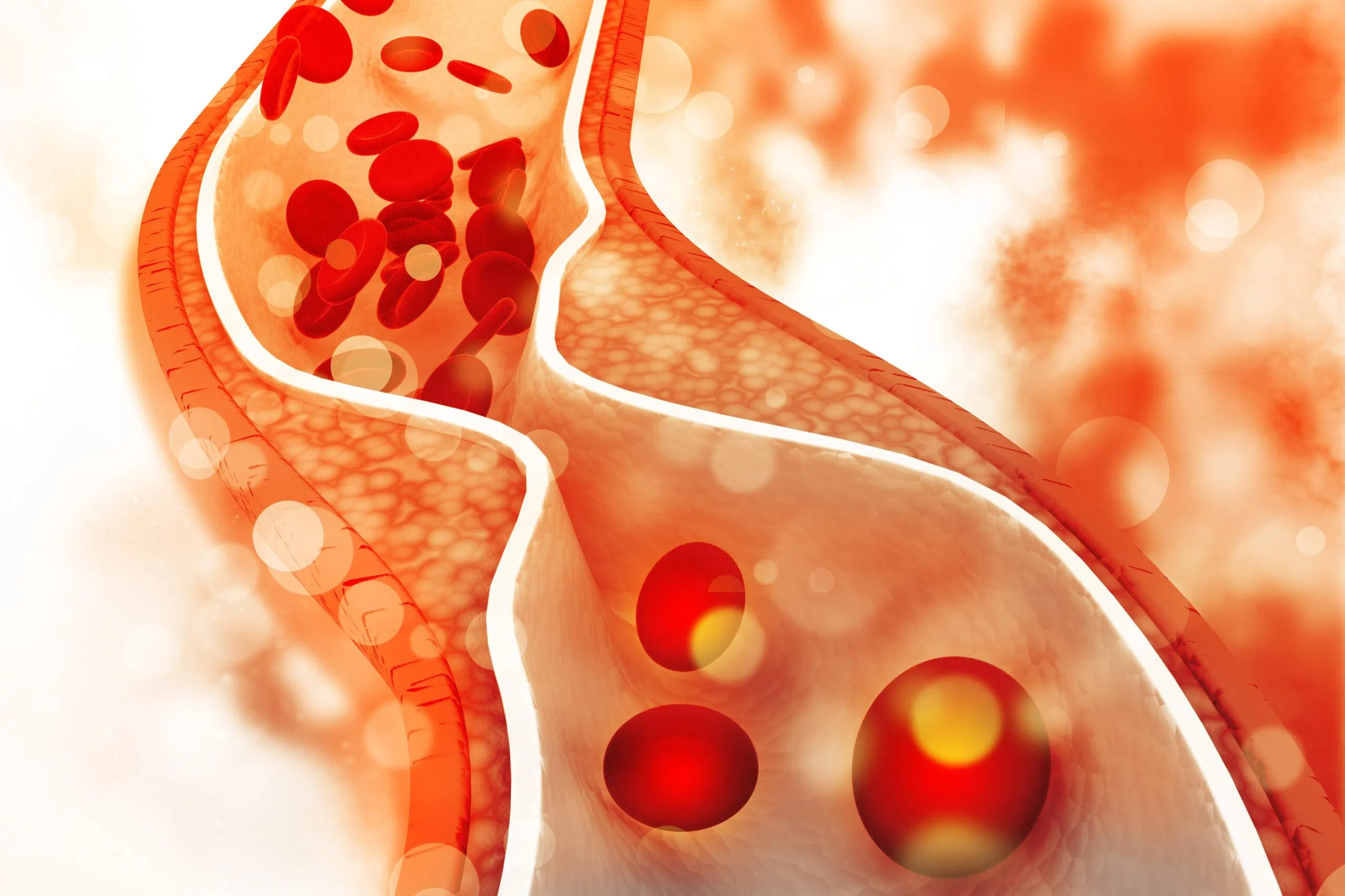 Có nhiều nguyên nhân khiến cholesterol LDL cao