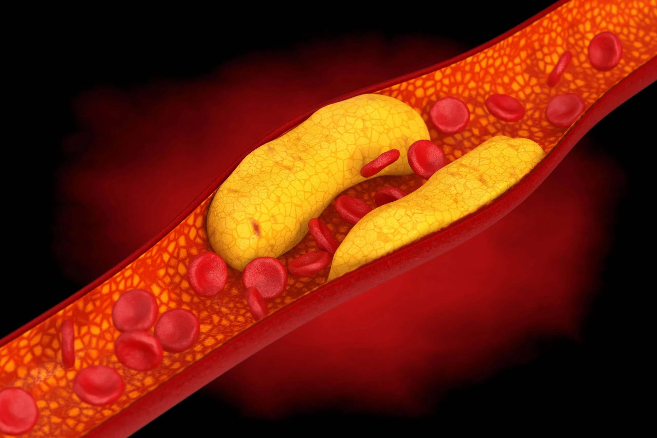 Cholesterol LDL cao