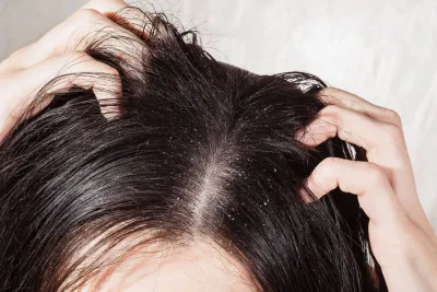 Gàu là tình trạng da đầu bị bong tróc