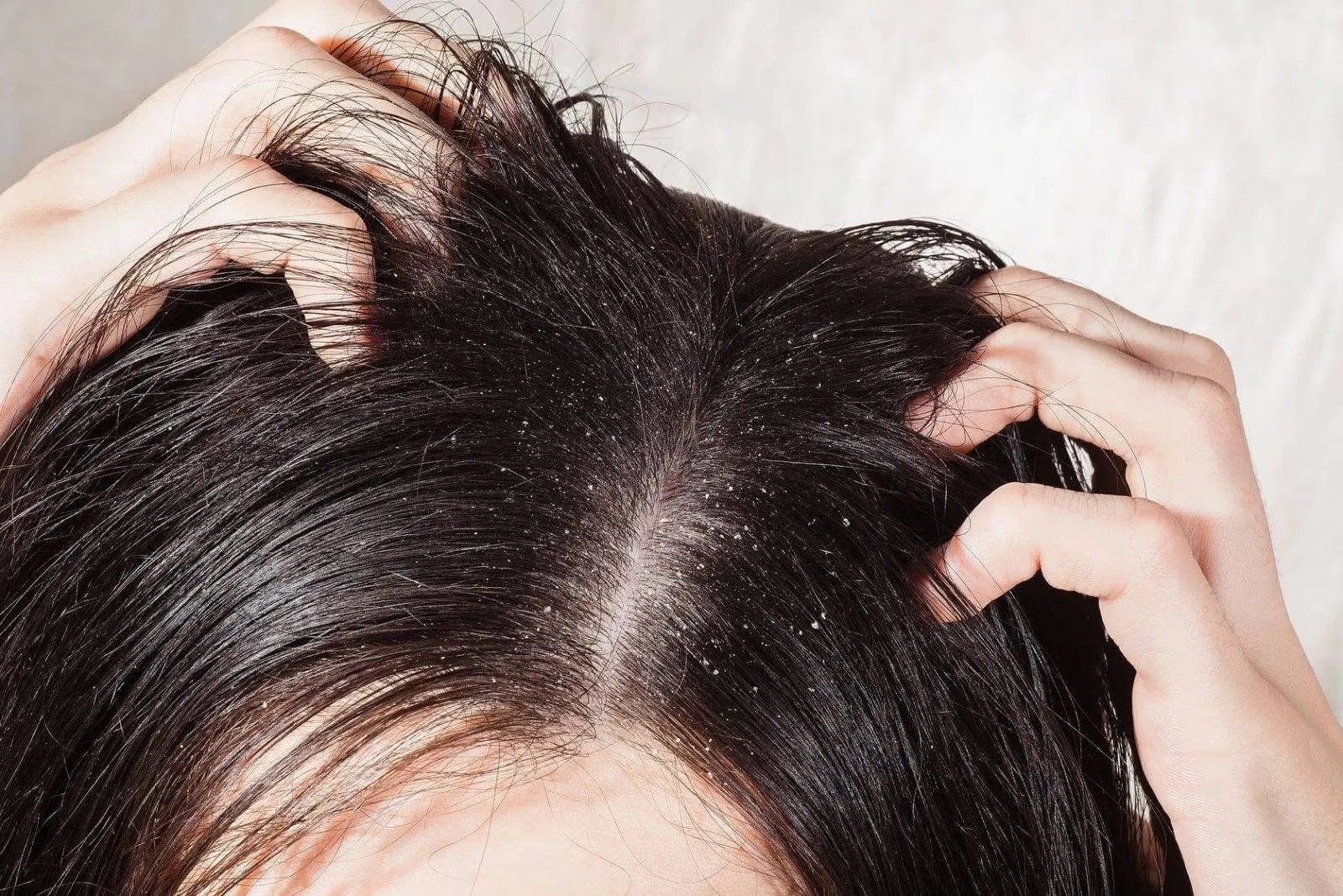 Gàu là tình trạng da đầu bị bong tróc