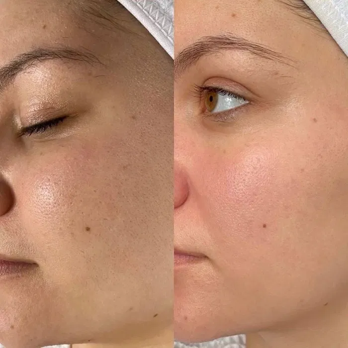 Lợi ích của việc cạo lông mặt