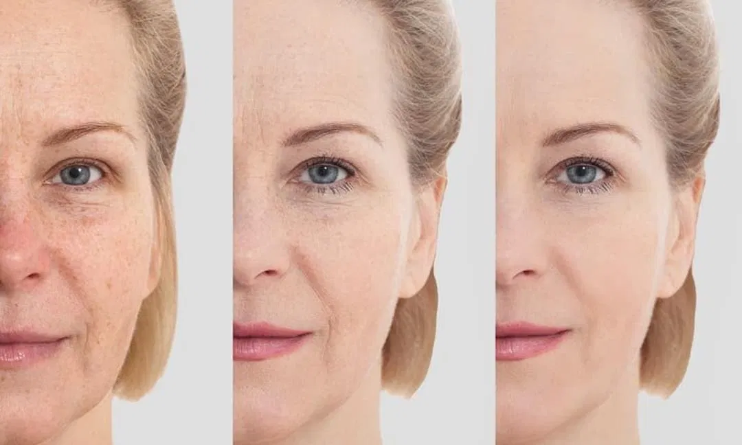 Phá hủy Collagen