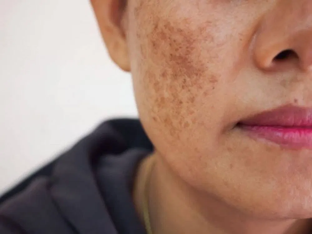 Gây phản ứng viêm và tăng sắc tố da