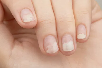 Nguyên nhân gây tách móng có thể xuất phát từ tác động tại chỗ hoặc các vấn đề sức khỏe