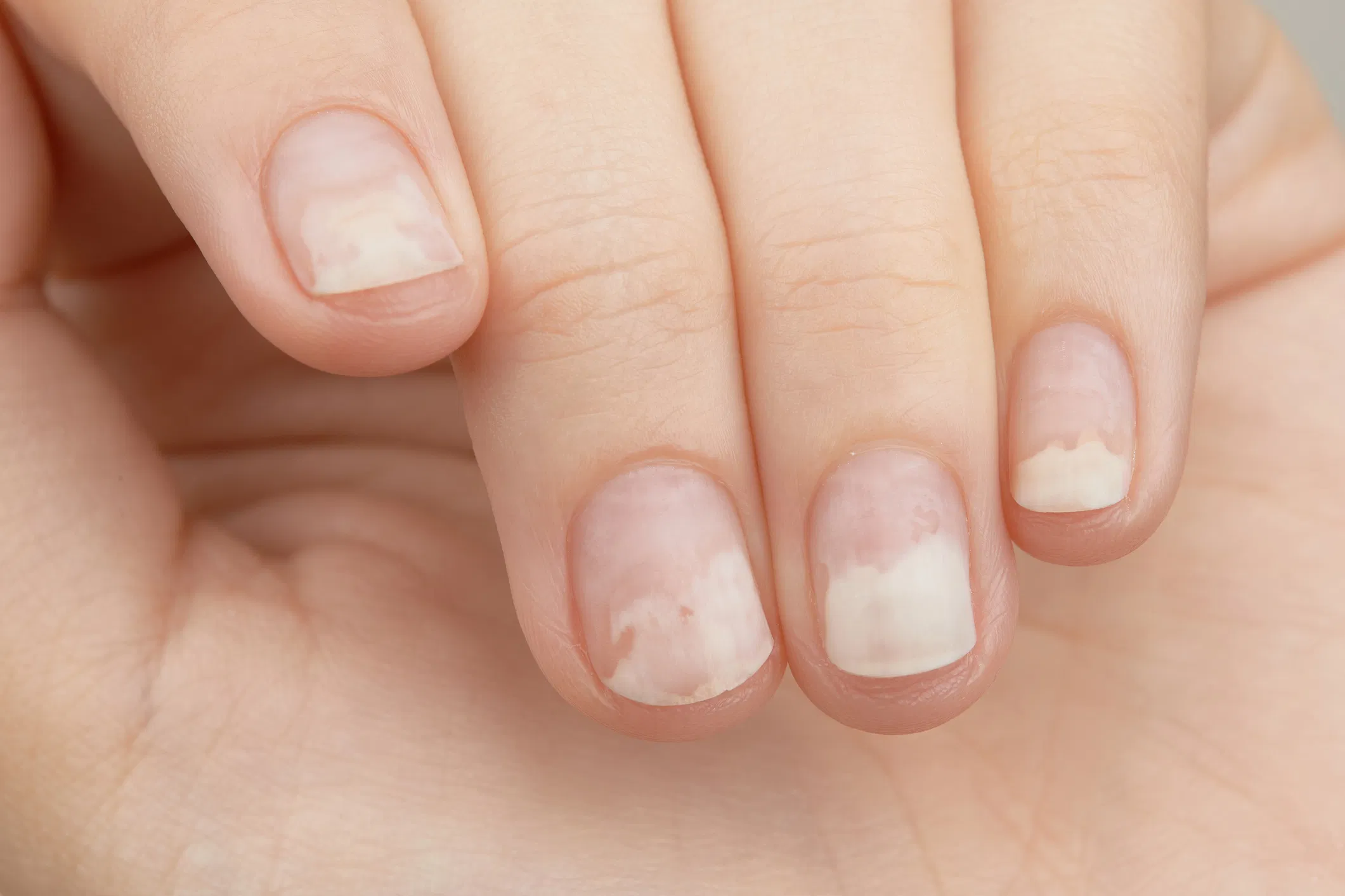 Nguyên nhân gây tách móng có thể xuất phát từ tác động tại chỗ hoặc các vấn đề sức khỏe