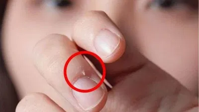 Xước măng rô