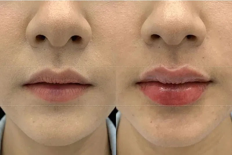 Tiêm filler môi bao lâu thì vào form