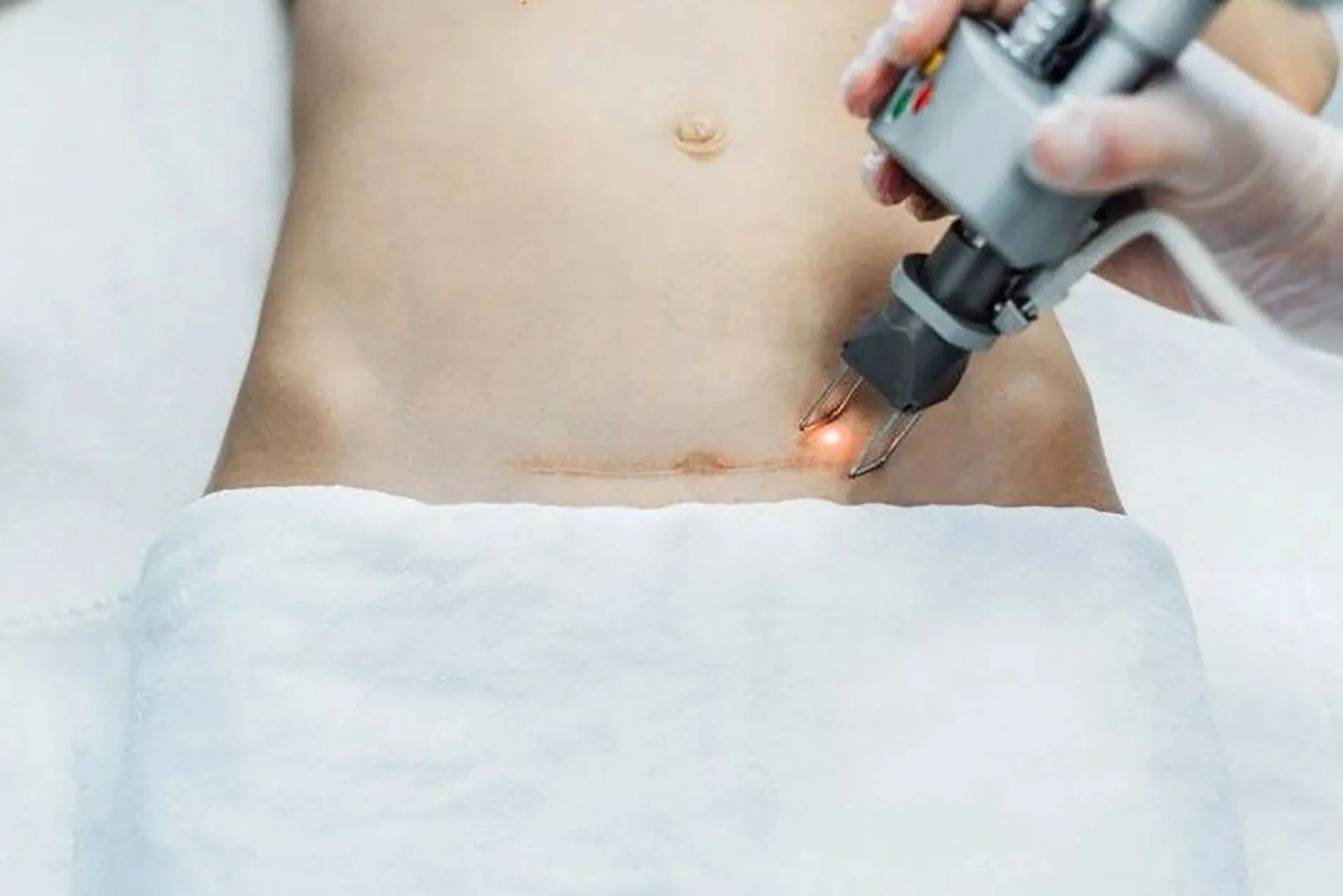 Liệu pháp laser